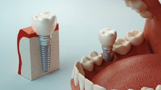 Types Of Dental Implants And Techniques: Which One Is Best For You?