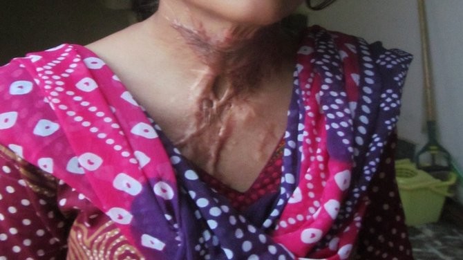 Helping Out Burn Victims Charity